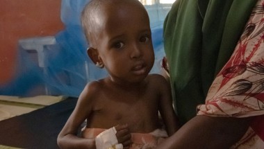 African infant girl suffering from wasting with tube in her hand