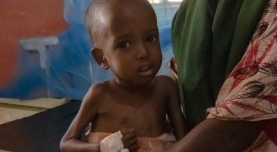 African infant girl suffering from wasting with tube in her hand